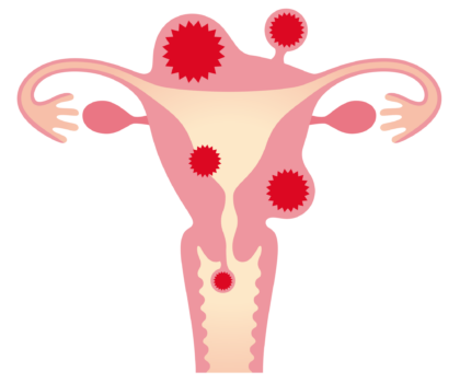 子宮筋腫イメージ