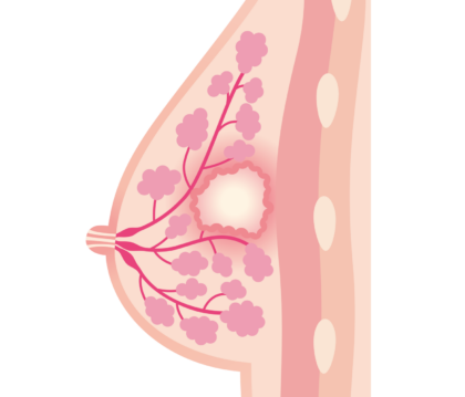 乳腺炎