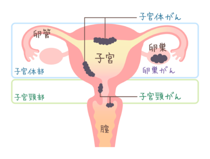 子宮頸がん